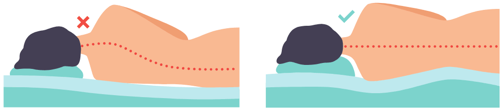 Folgen eines falschen Matratzen Härtegrades bzw. einer zu weichen Matratze - schiefe Wirbeksäule